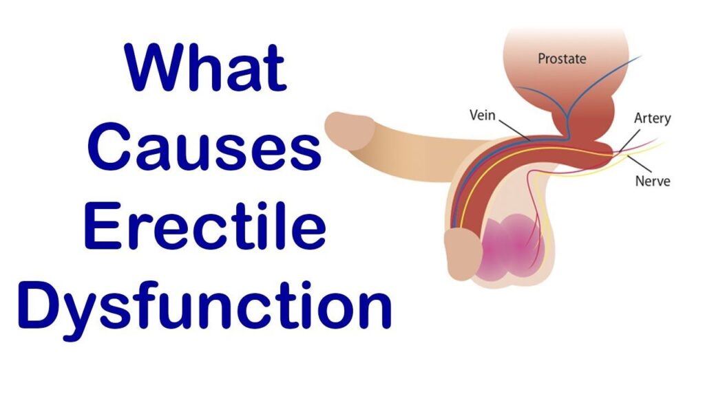 What Causes Erectile Dysfunction?