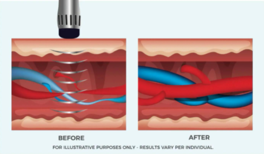 Pulse Wave Therapy for Sexual Health