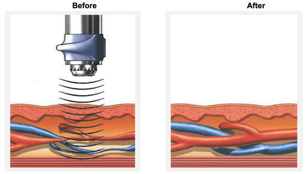 Shockwave Therapy And Acoustic Therapy For ED